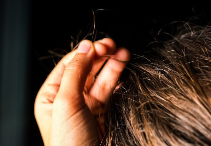 هوس نتف الشعر: الأعراض والاسباب والعلاج